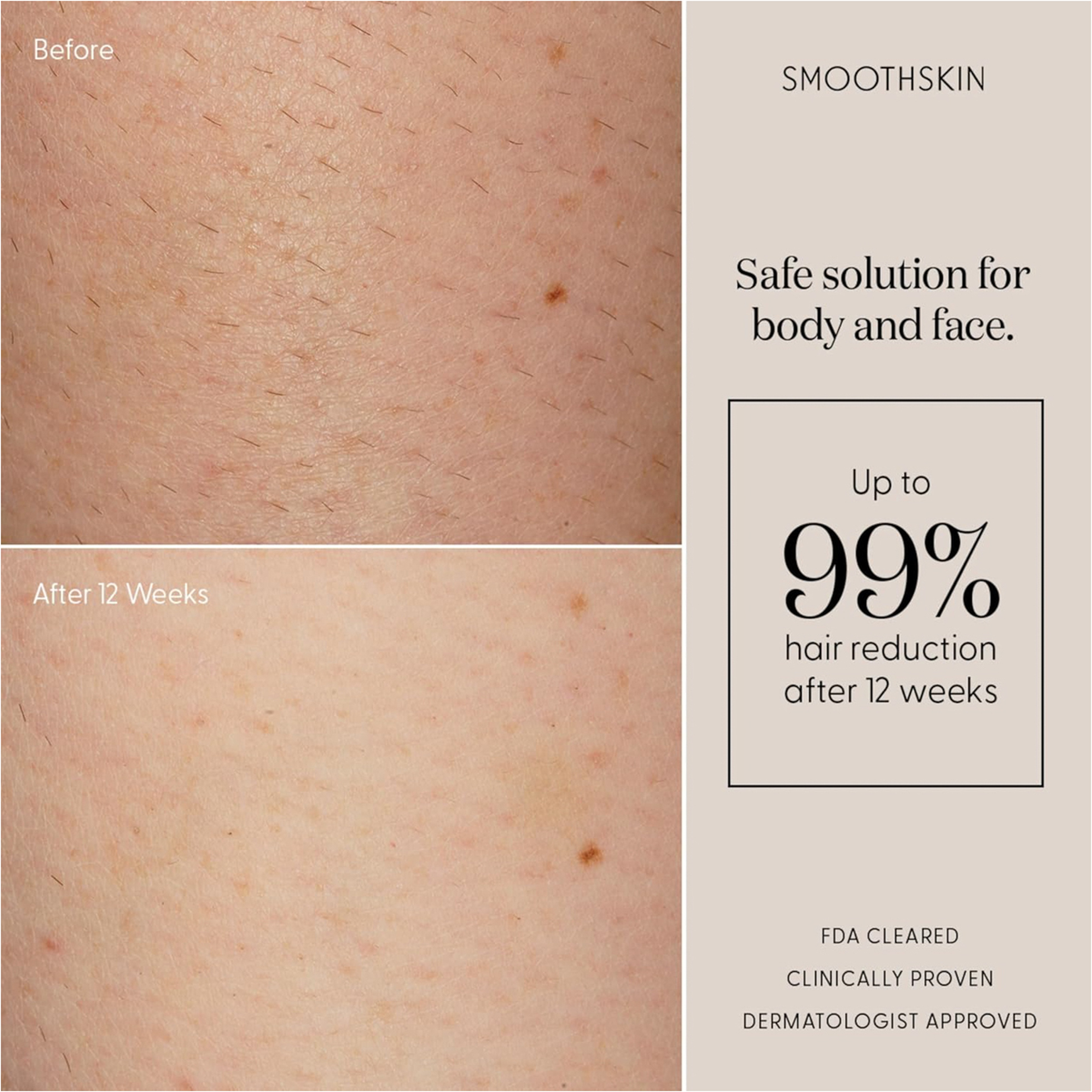 Smoothskin Pure Fit Ipl Hair Removal Device