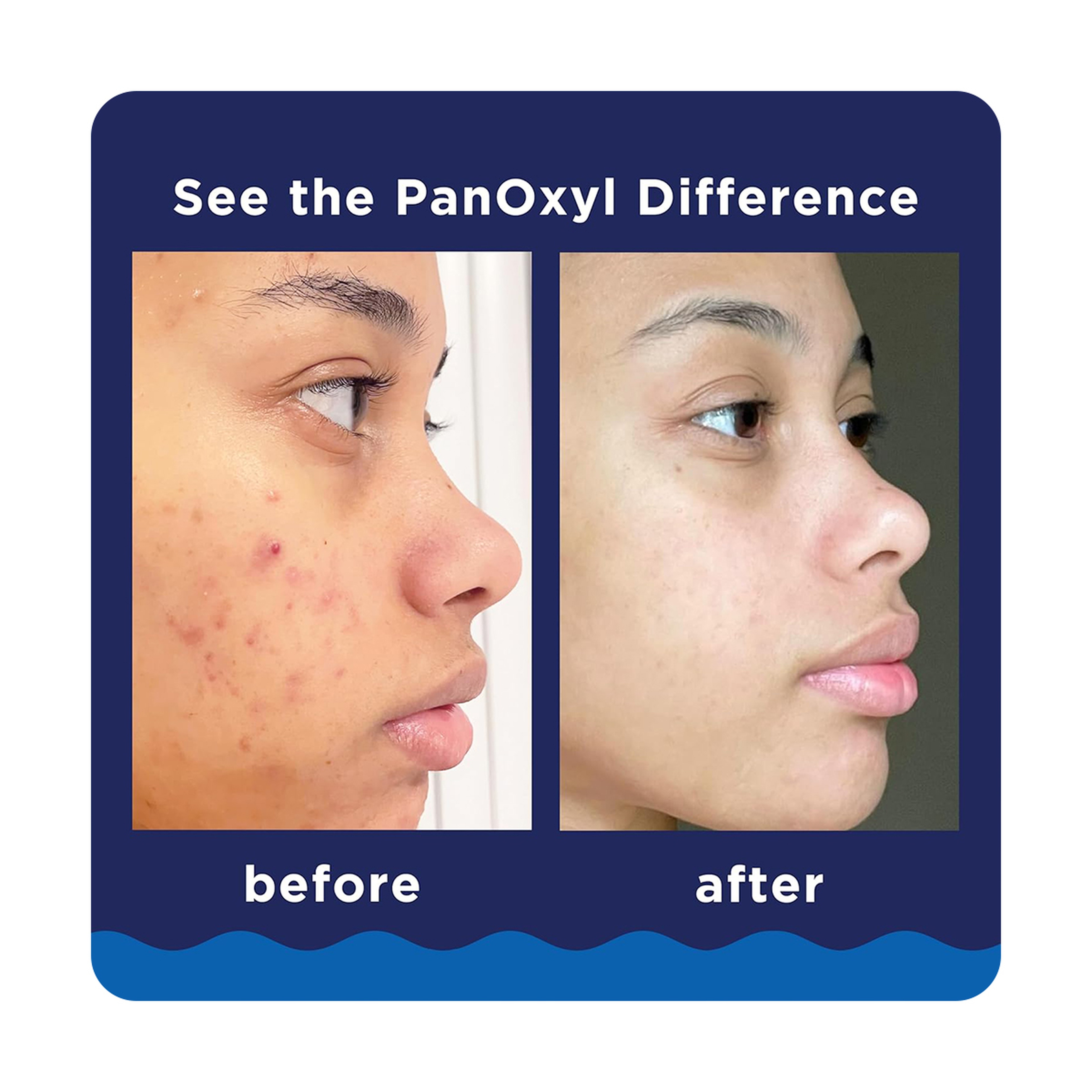 Panoxyl Acne Foaming Wash 10% Benzoyl Peroxide 156g