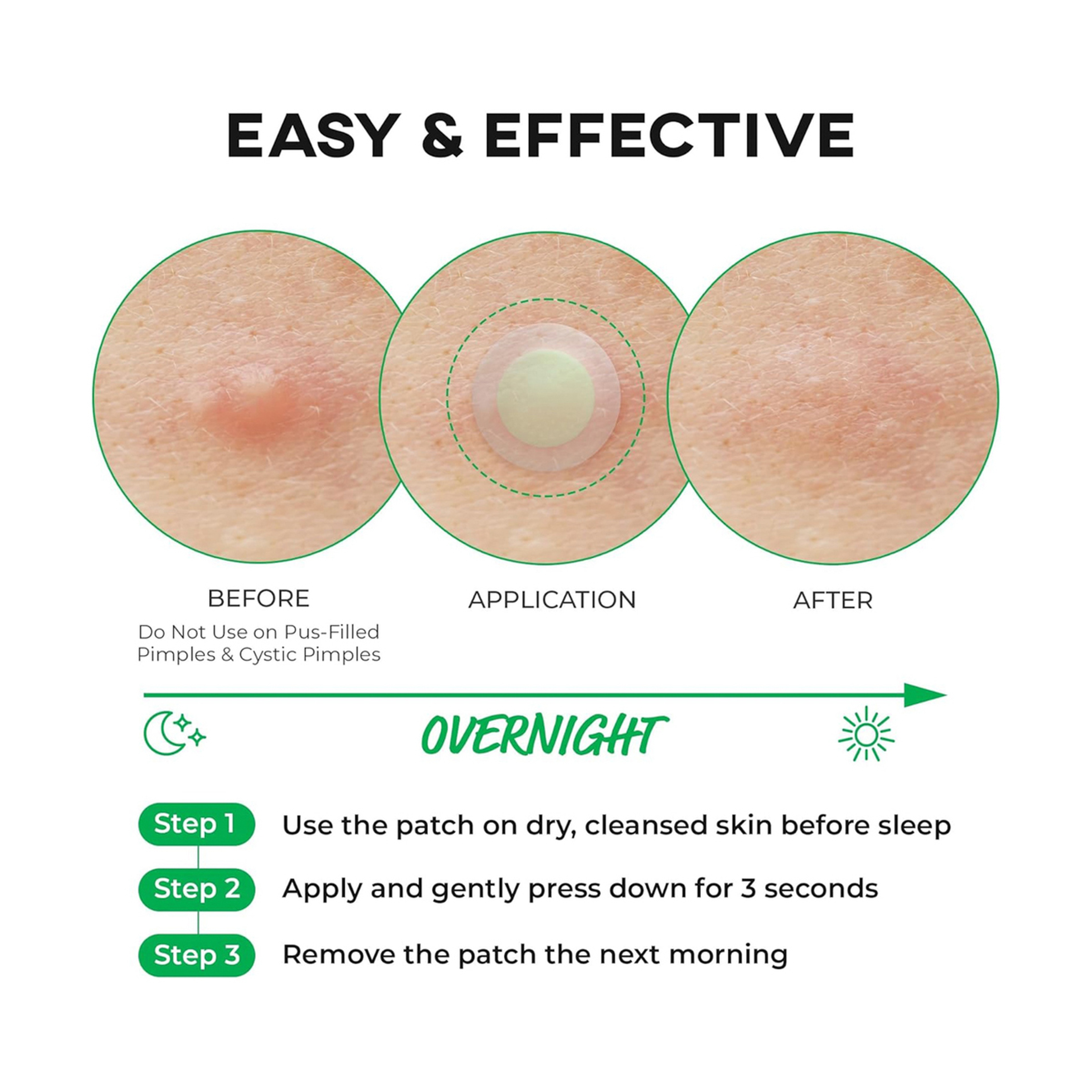 نولاهور رقعة حب الشباب مزيل بقع خضراء