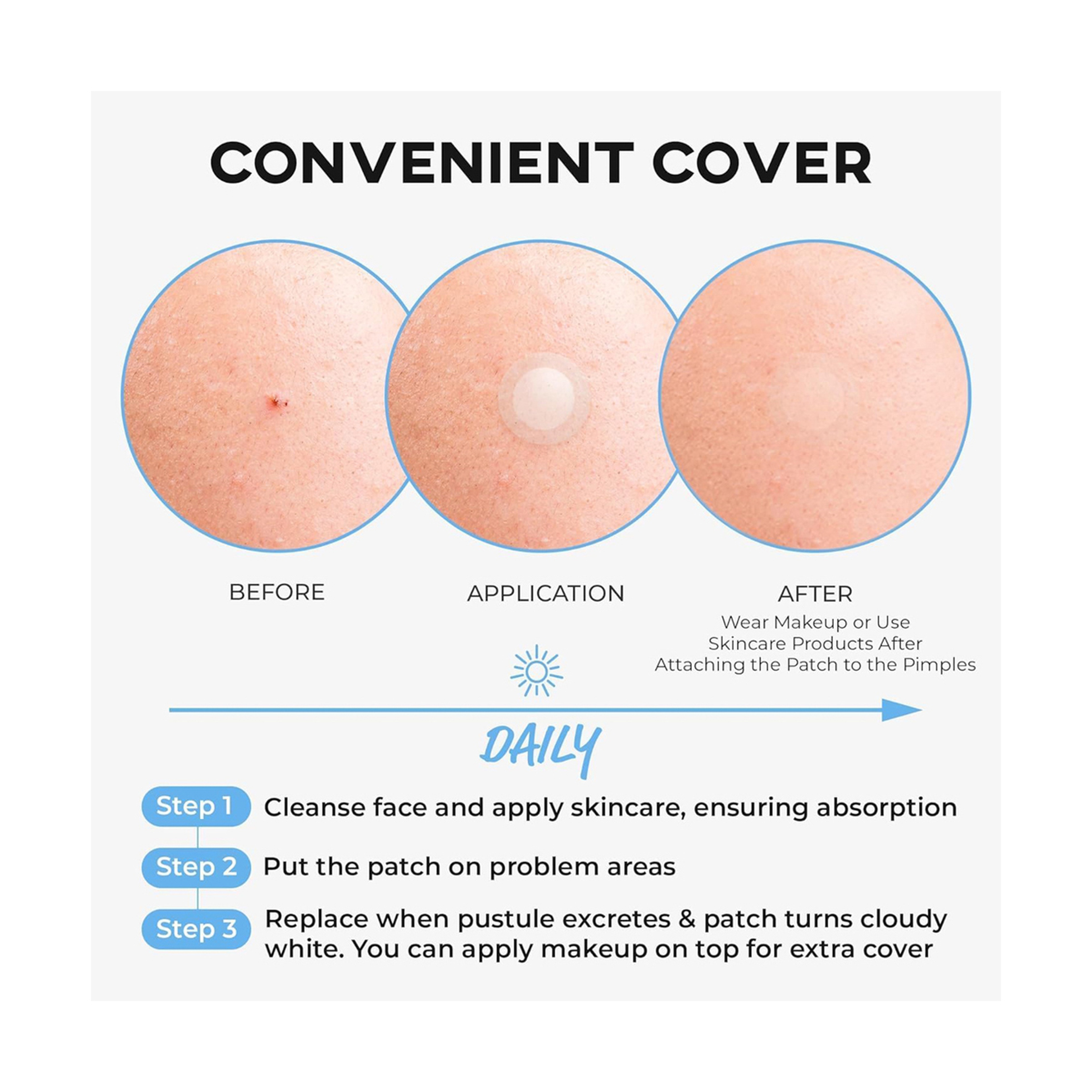 نولاهور رقعة حب الشباب مزيل بقع زرقاء