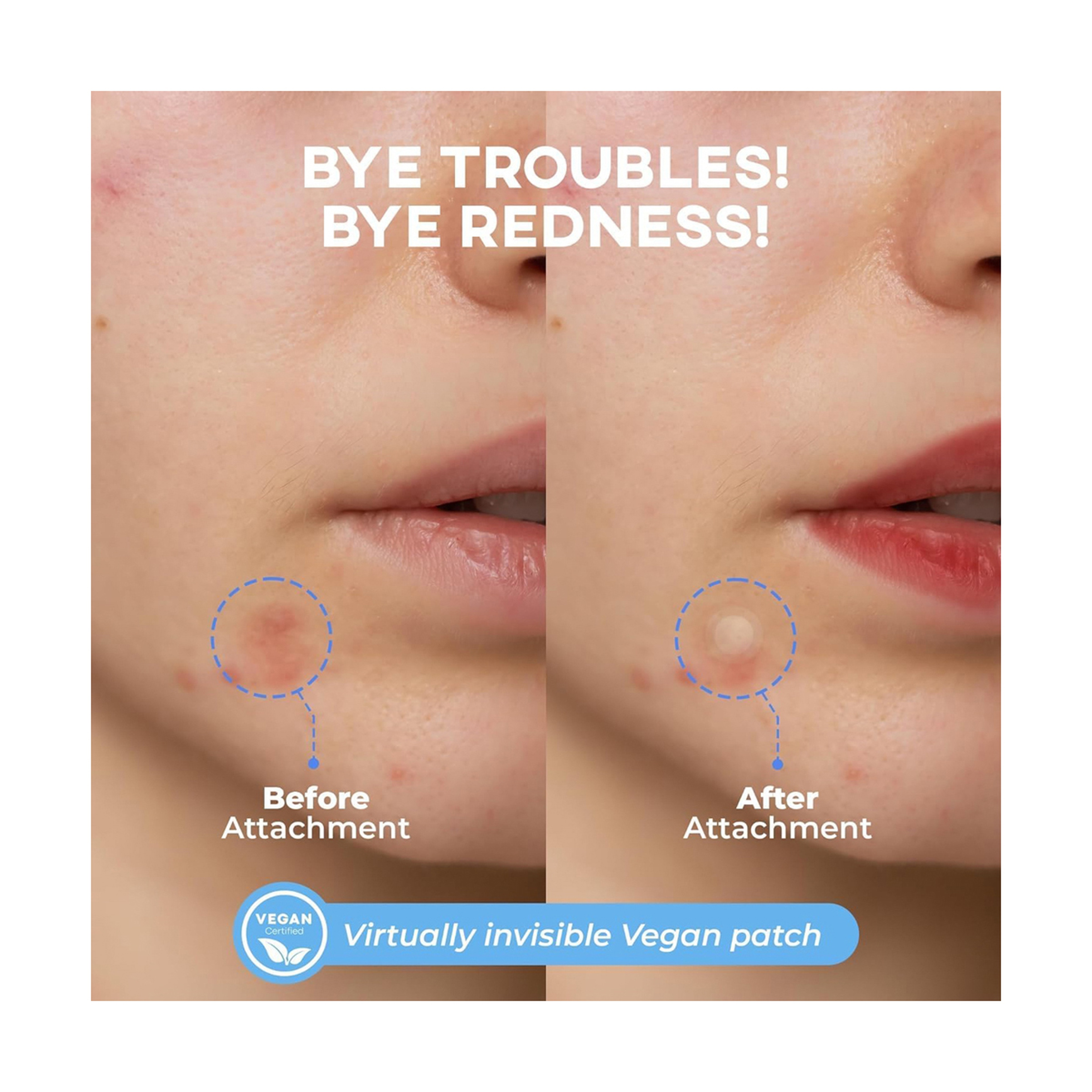 نولاهور رقعة حب الشباب مزيل بقع زرقاء