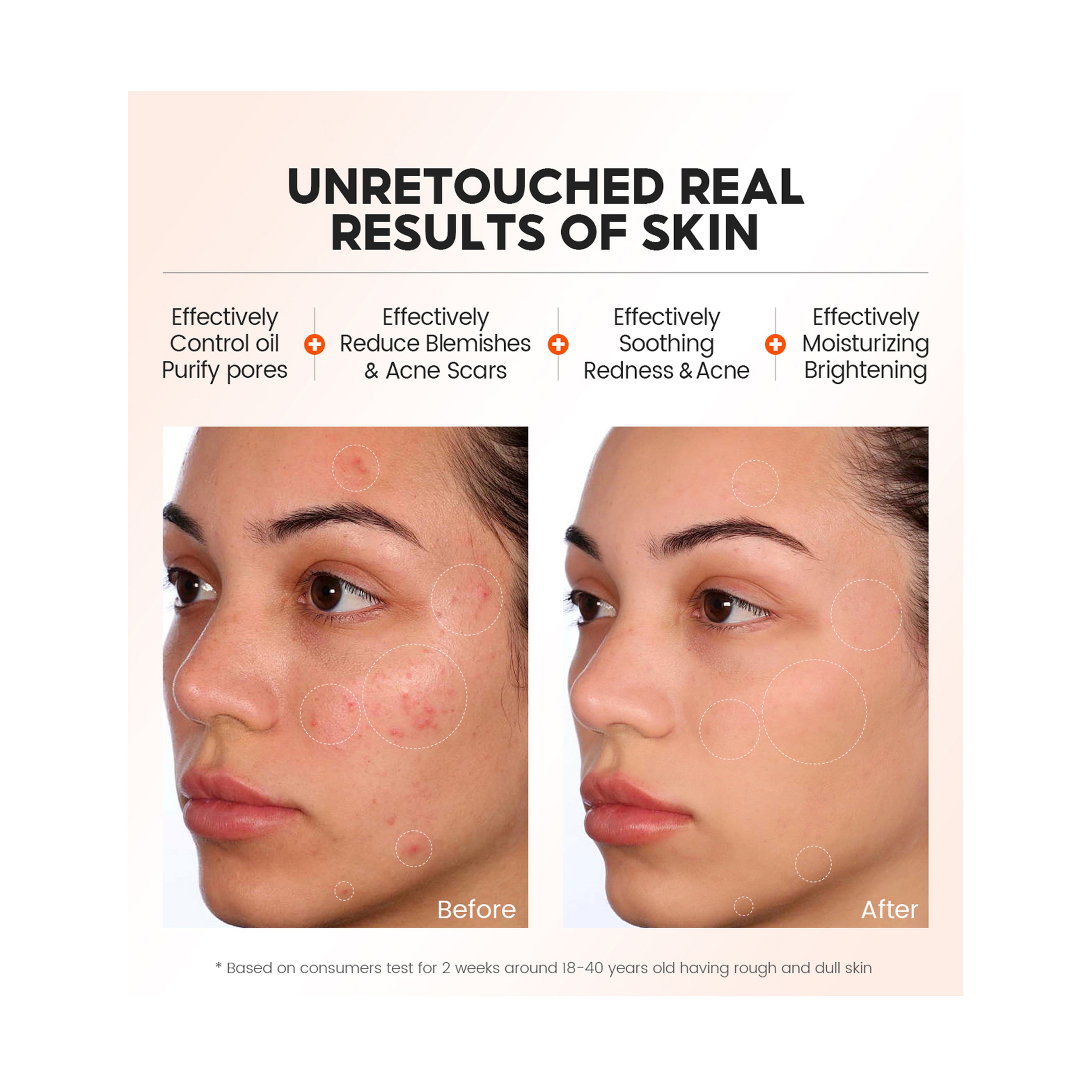 Vibrant Glamour 2% Salicylic Acid Exfoliating Serum Anti-Acne 30 ml