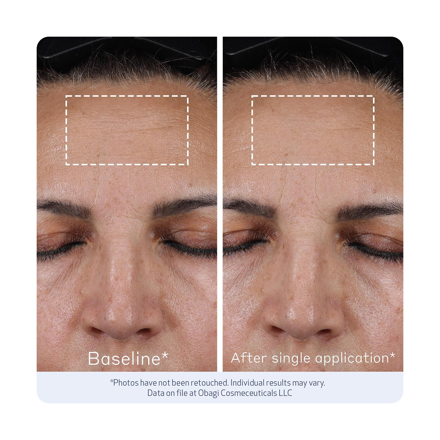 أوباجي إيلاستيديرم فيلر 20مل